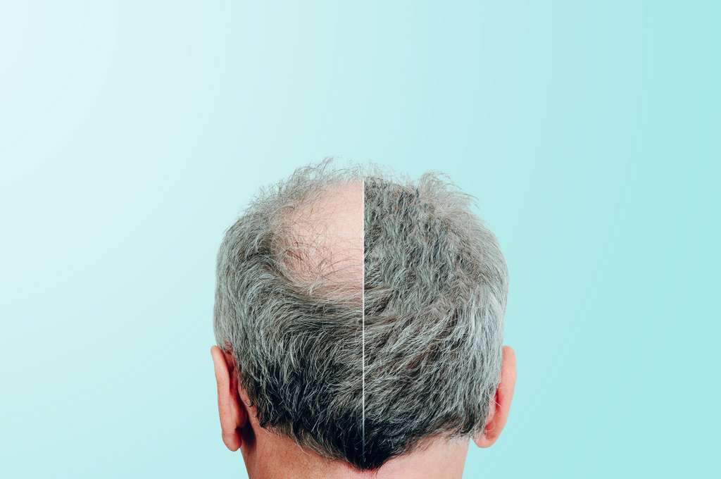Tout ce que vous désirez savoir sur la greffe de cheveux Aptaa.fr — free download
