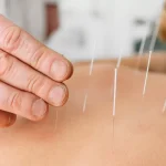 Acupuncture : les tarifs des consultations et les remboursements expliqués