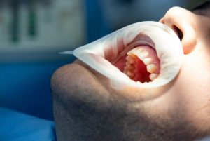 Bouche d'un patient en clinique dentaire